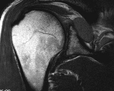 Spinoglenoid cyst Coronal MRI